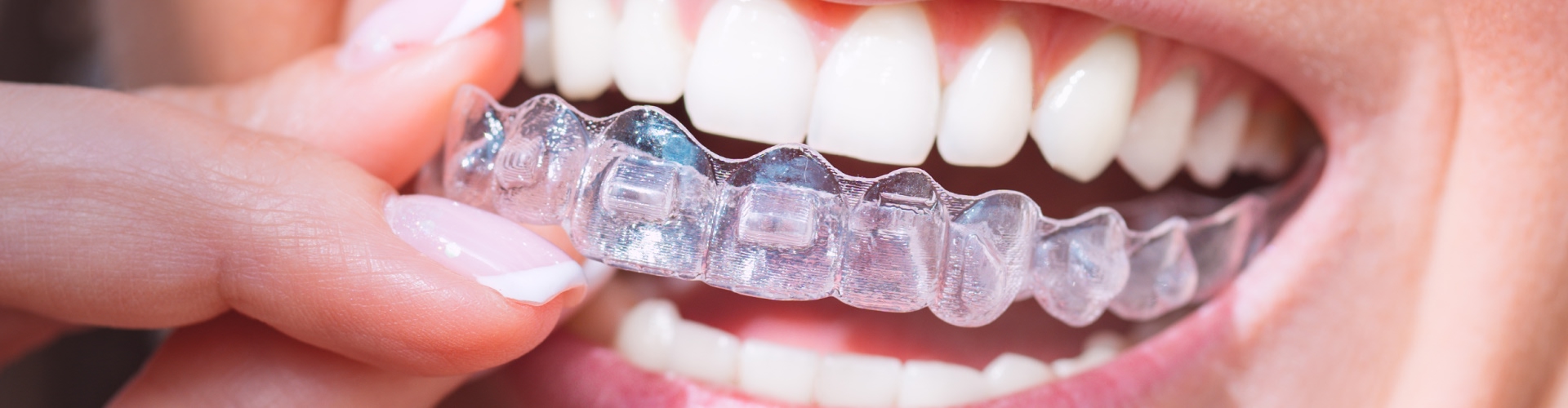 Woman placing clear aligner in her mouth.